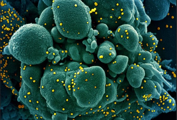 this image illustrates the electron microscopic appearance of the SARS-CoV-2 virus emerging from dying cells.